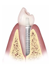 thousand oaks dental implants